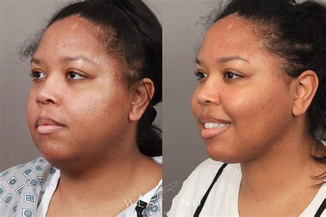 buccal fat removal leeds